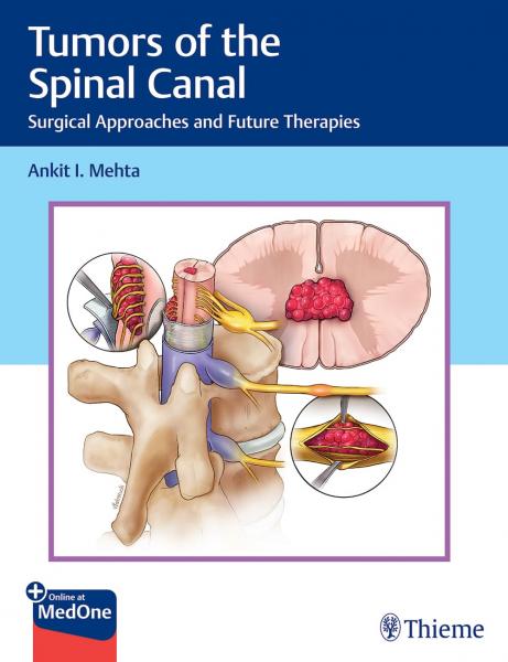 Tumors of the Spinal Canal: Surgical Approaches and Future Therapies 2022 - جراحی